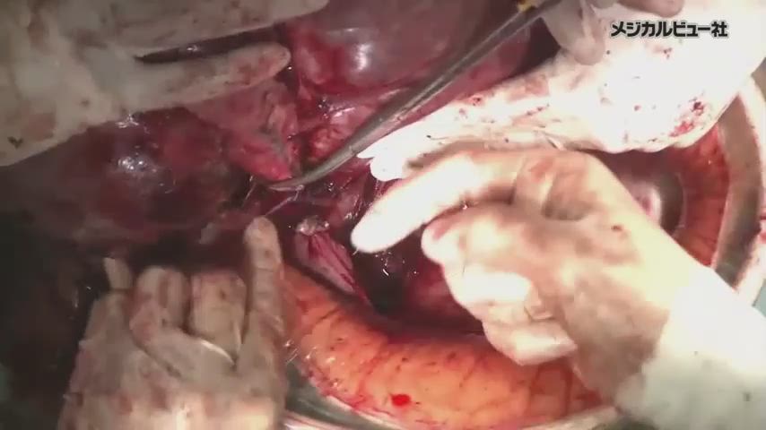 [A11829586]伝えたい私の手術 ArtとScienceの融合?動画で伝授する産婦人科手術の究み (OGS NOW No. 24)