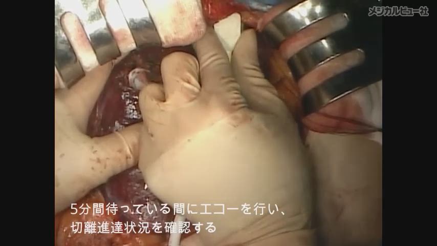 肝癌に対する標準手術［Web動画付］−手技習得へのナビゲート