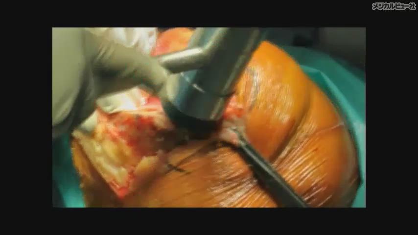 メジカルビュー社｜Movie Archives｜『阪和人工関節センター TKA