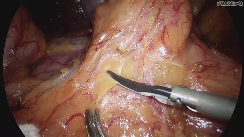 リンパ節郭清手技を究める[下部消化管編]［Web動画付］ (新DS