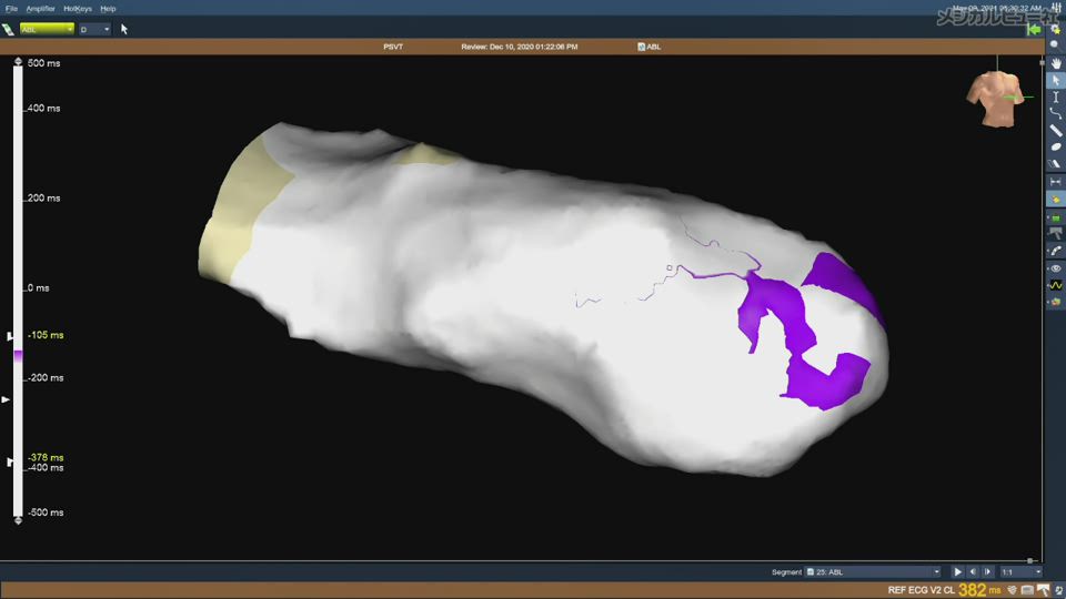 3Dマッピングシステム徹底攻略! : アブレーション治療成績を上げよう