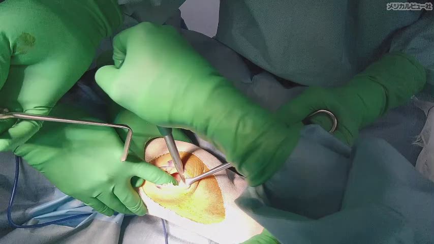 新OS NEXUS No.14 上肢の関節温存手術 メジカルビュー社｜整形外科｜新OS NEXUS No.14 上肢の関節温存