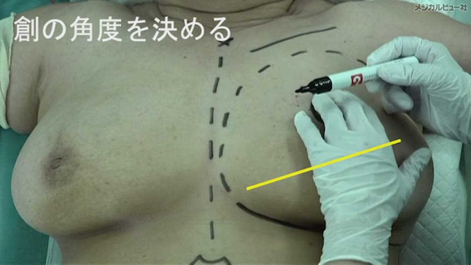 スタンダード乳癌手術 スタンダード乳癌手術 メジカルビュー社｜胸部外科・呼吸器外科